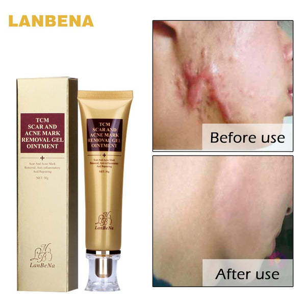 Acne Scar Removal Cream 30ml